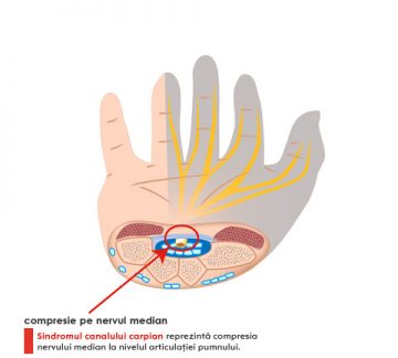 cum se tratează sindromul articulației carpiene)