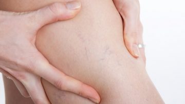 Durere la nivelul picioarelor cu varice: simptome, diagnostic și tratament - Complicaţiile - April