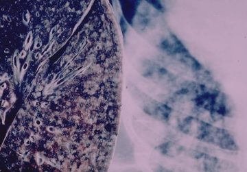 COVID-19: Peste 5.000 de decese în Brazilia