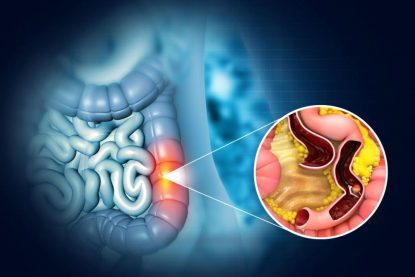 Polipii colonici: de ce apar, cum se manifestă și cum pot fi diagnosticați (P)