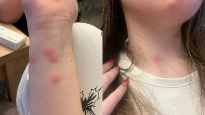 O tânără acuză că a fost mușcată de ploșnițe într-un tren CFR București–Sighet. Mama sa a reclamat compania de stat | AUDIO